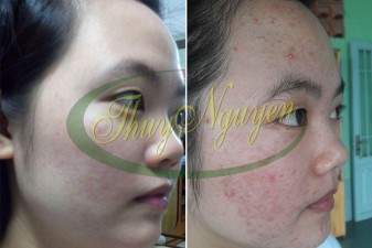 Điều Trị Mụn Cám - Mụn Đầu Đen - Mụn Mũ - Thâm - Da Nhờn - MSKH 25106